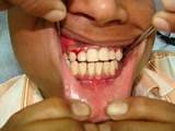 I Have Gum Disease But No Insurance