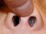 Images of Inflamed Nostrils Home Remedies