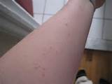 Photos of Bed Bug Treatment On Skin