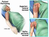 Images of Recovery After Shoulder Replacement Surgery