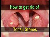 Tonsilloliths Home Remedies Pictures