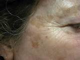 Age Spot Removal Dermatologist Pictures