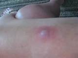 Can U See Bed Bugs Pictures