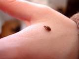 Images of Treatment For Bed Bugs For Humans