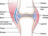 Arthrosis Medical Definition