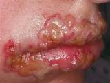 Herpes On Foot Treatment Images