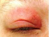 Pictures of Eyelid Allergies Home Remedies