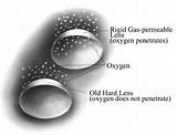 Images of Cost Of Gas Permeable Contact Lenses