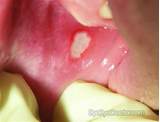 Sore On My Gums Treatment