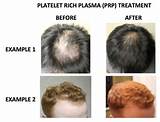 Blood Platelet Hair Loss Treatment Images