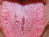 Pictures of Fissured Tongue Home Remedies