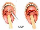 Laser Snoring Treatment Cost Images