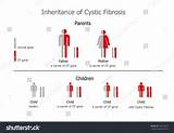 Cystic Fibrosis Gene Carrier Images