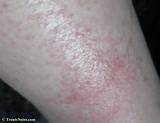 Shiitake Dermatitis Treatment Images