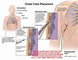 Images of Tube Thoracostomy Procedure