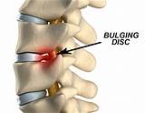 Cervical Spine Disc Bulge Treatment Images