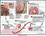 What Is The Medical Condition Sepsis