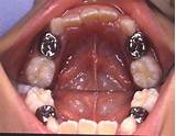 Images of Silver Crown Teeth