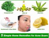 Images of Pimple Spot Removal Home Remedies