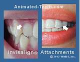 Orthodontic Composite Buttons Photos