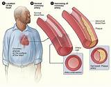 Images of Can You Have Congestive Heart Failure With A Pacemaker