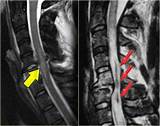 Bruised Spinal Cord Recovery Pictures