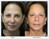 Images of Recovery Time Co2 Laser Skin Resurfacing