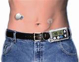 Medtronic Insulin Pump Images