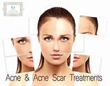 Images of List Of Acne Treatments