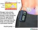 Images of What Is An Insulin Pump