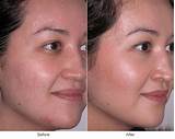 What Do Microdermabrasion Treatments Do Photos