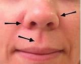 Pictures of Dry Nostrils Treatment
