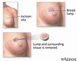 Images of How Does Radiation Affect The Body During Cancer Treatments