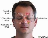 Images of Frontal Headache Treatment