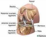 Images of Posterior Cruciate Ligament Tear Treatment