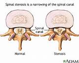 Exercises Spinal Stenosis Photos