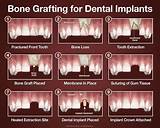 Images of Bone Graft Recovery