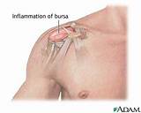 Photos of Bursitis Medical Definition