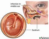 Medication For Inner Ear Infection In Adults