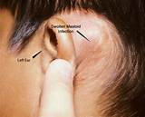 Images of Ear And Head Pain On Right Side