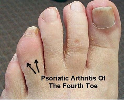 Pictures of Great Toe Arthritis Treatment