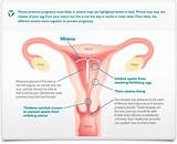 Images of Iud 3 Year Side Effects