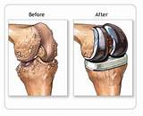 Knee Joint Therapy Pictures