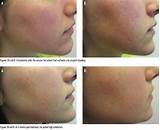 Dermapen Micro Needling Treatment Of Acne Scars Pictures
