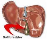 Gallbladder Emergency