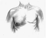 Can Men Get Breast Cancer