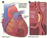 What Can Cause Coronary Artery Disease
