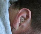 Images of Swimmers Ear Infection Treatment
