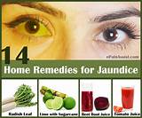 Photos of Jaundice Symptoms And Treatment