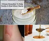 Home Remedies Minor Burns Images